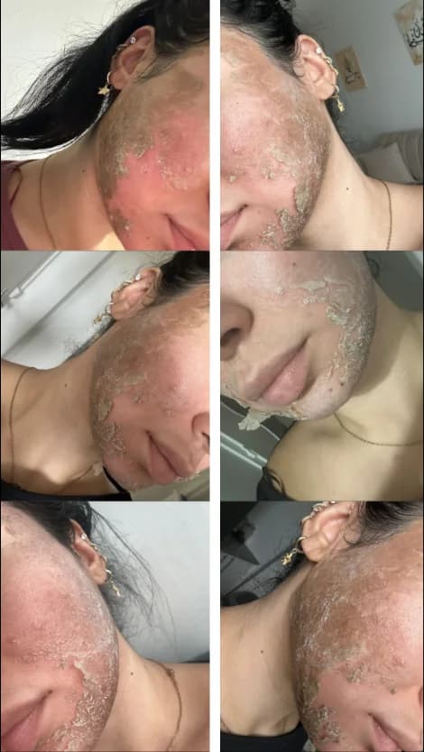 Avant après acné après protocole peeling aux algues
