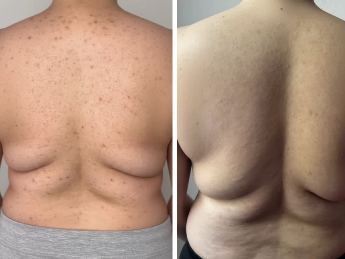 Avant après taches pigmentaires après protocole peeling aux algues