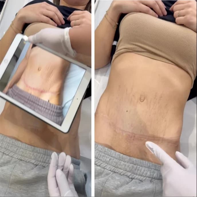 Avant après cicatrice après protocole peeling aux algues